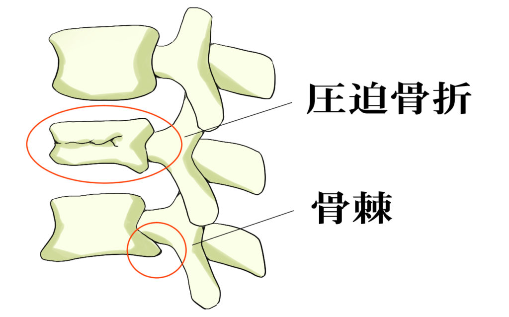 頚椎症の圧迫骨折・骨棘のイラスト