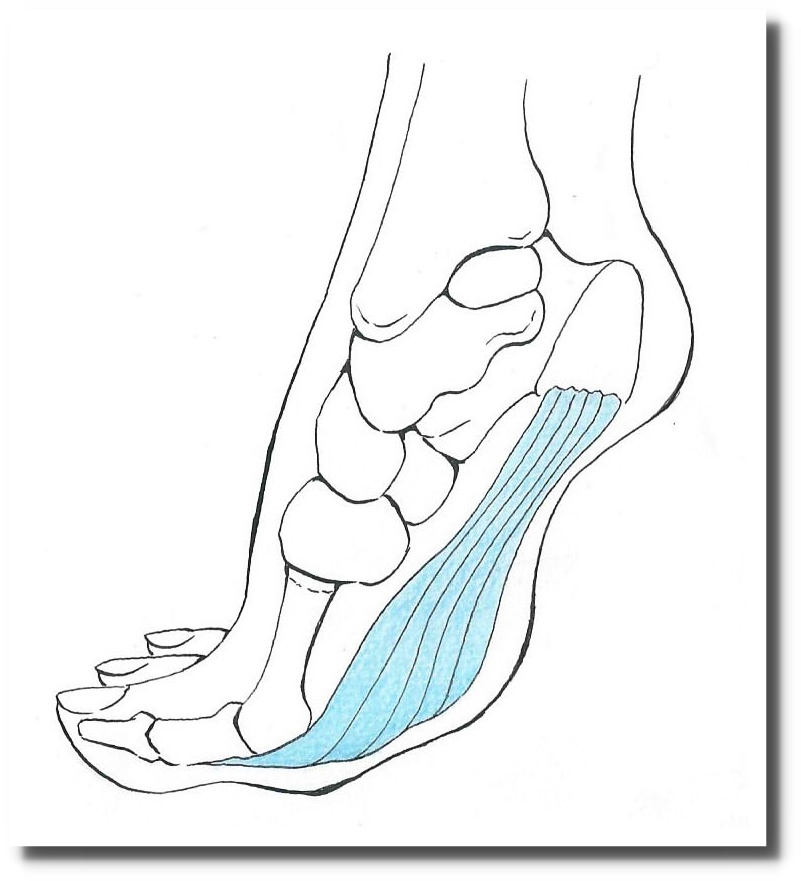 足底腱膜炎のイラスト