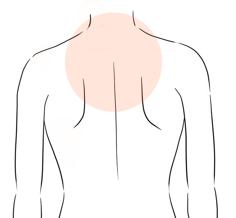 肩こりの鍼灸症例１の症状の出ている箇所
