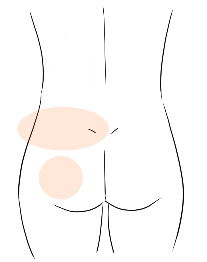 ぎっくり腰の鍼灸症例３の症状の出ている箇所