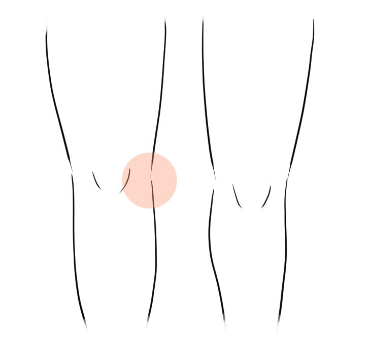 膝痛の鍼灸症例１の痛めている箇所