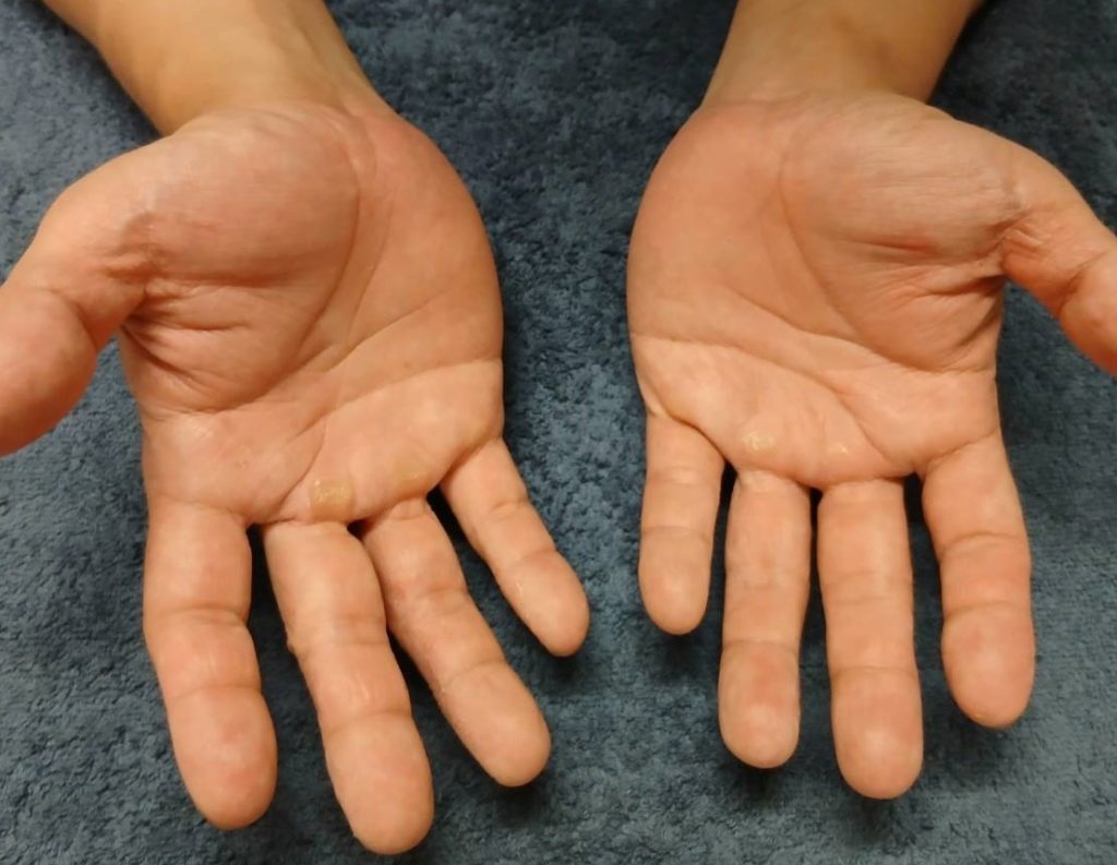 汗疱が治まった今の手